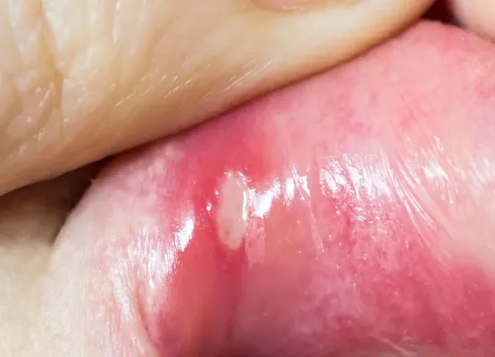 Jakie składniki pasty do zębów mogą nasilać objawy aft?