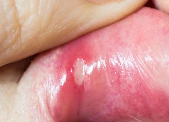 Dlaczego drapanie lub dotykanie afty może wydłużyć leczenie?