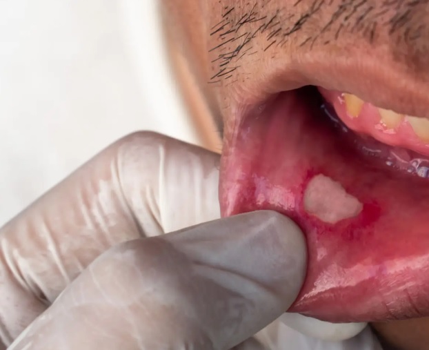 Jak niedobory witamin mogą spowolnić gojenie aft?