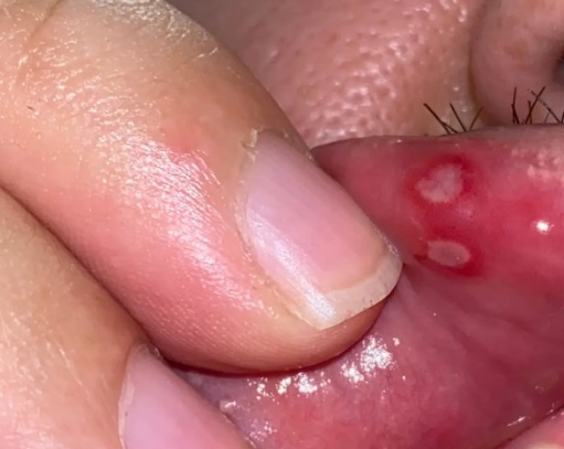 Jakie czynniki wpływają na skuteczność łagodzenia bólu przy różnych aftach?